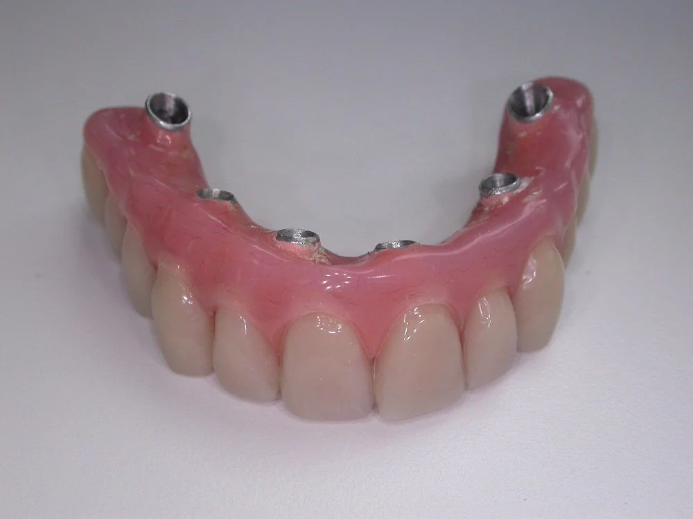 Bridge complet sur implant
