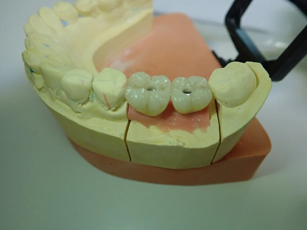 Couronne sur implant transvissé