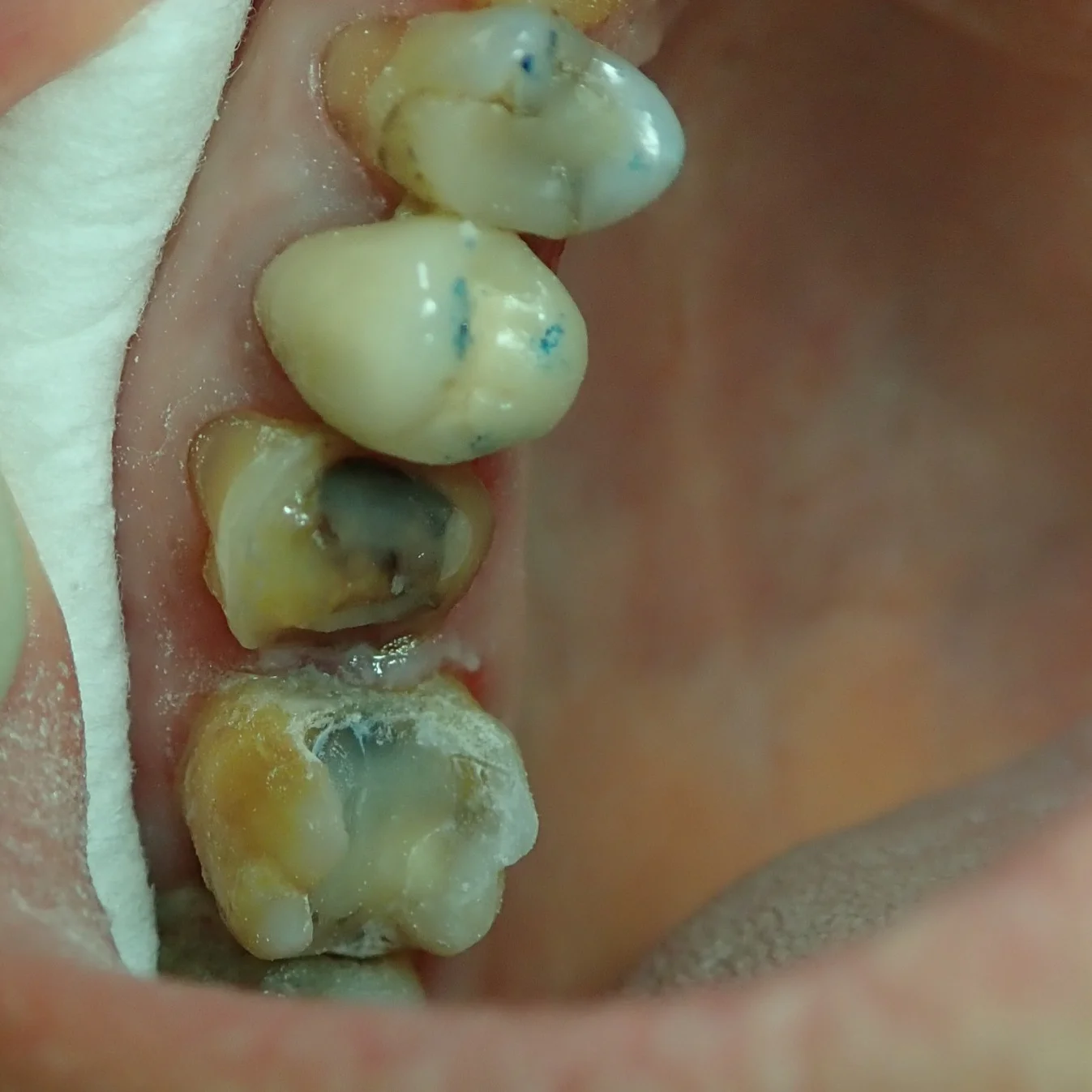 Dent abimée