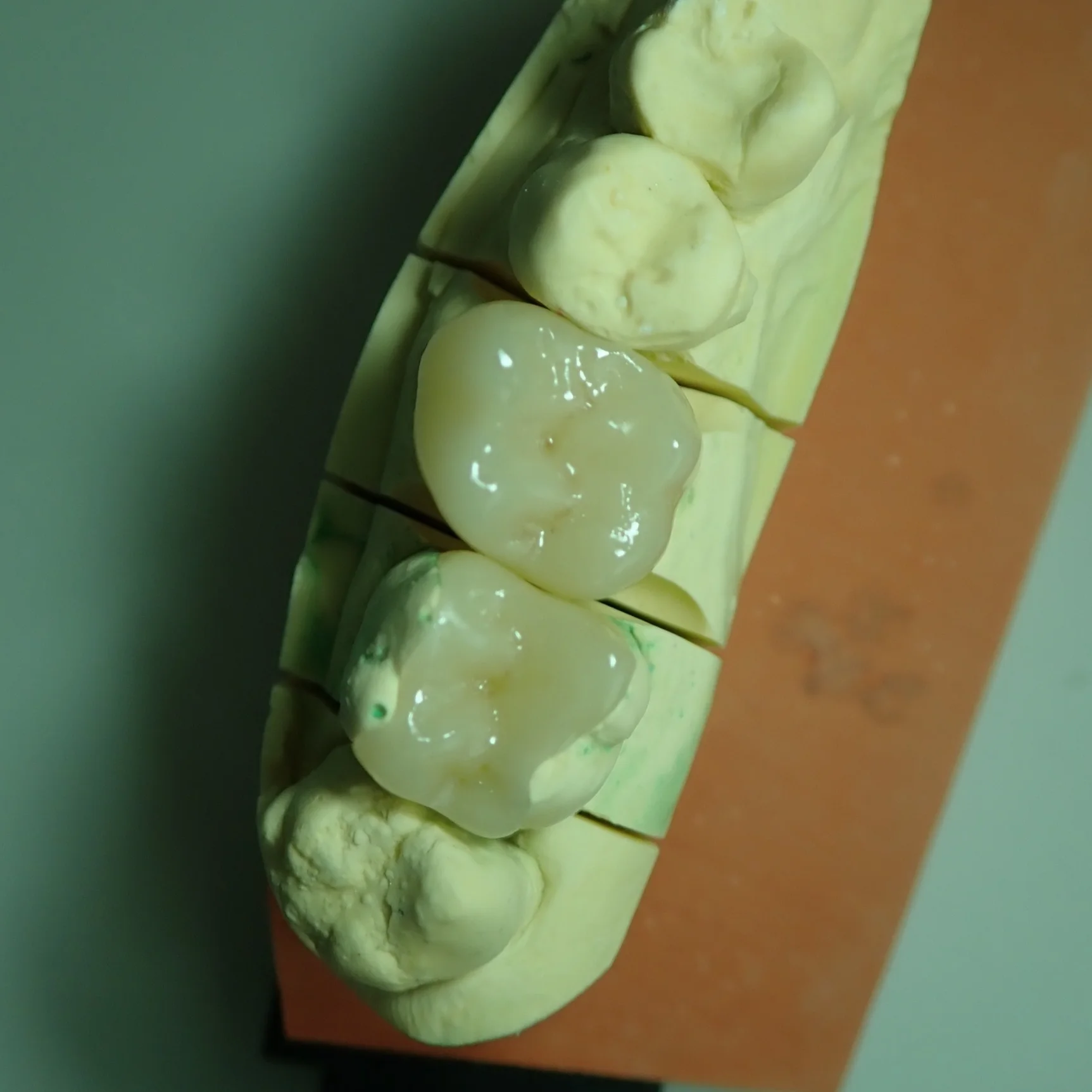 Inlay céramique réalisé au laboratoire