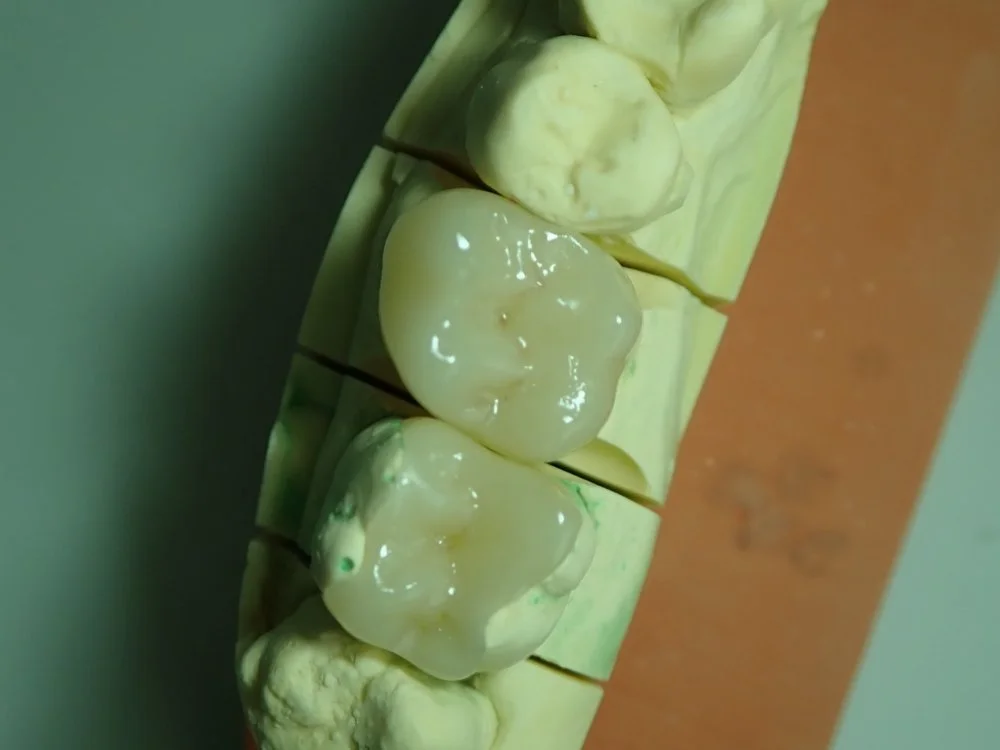 Inlay céramique