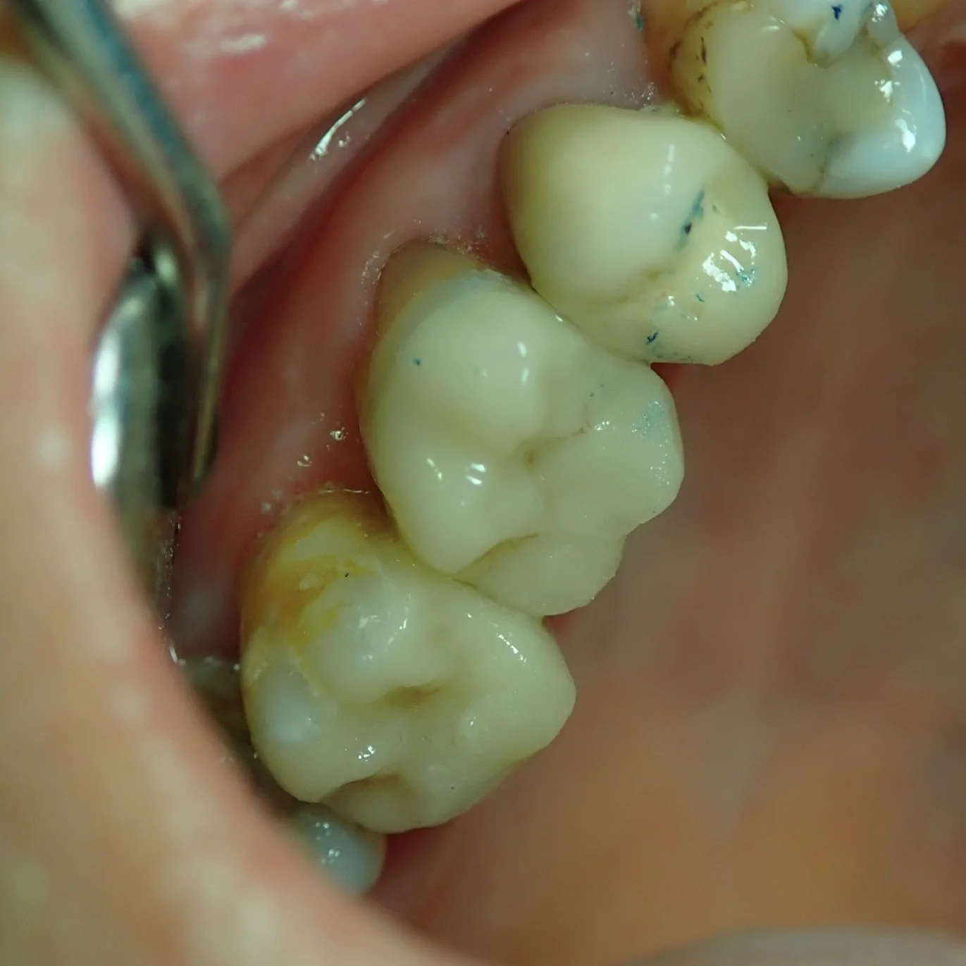 Onlay et inlay en bouche