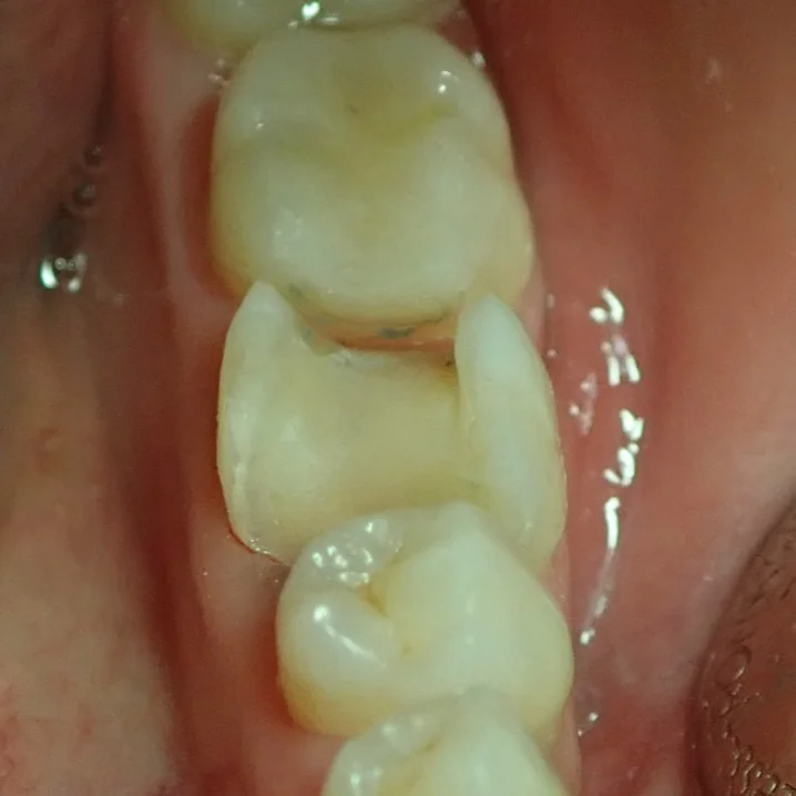 Treated-caries
