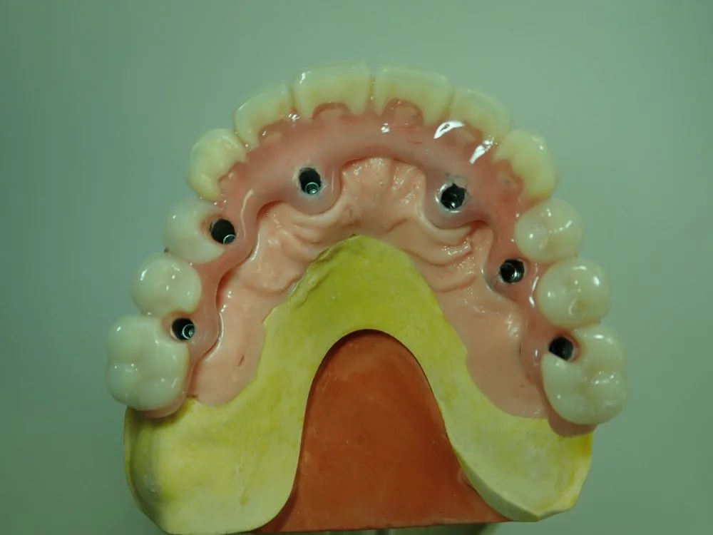 bridge complet sur implant transvissé