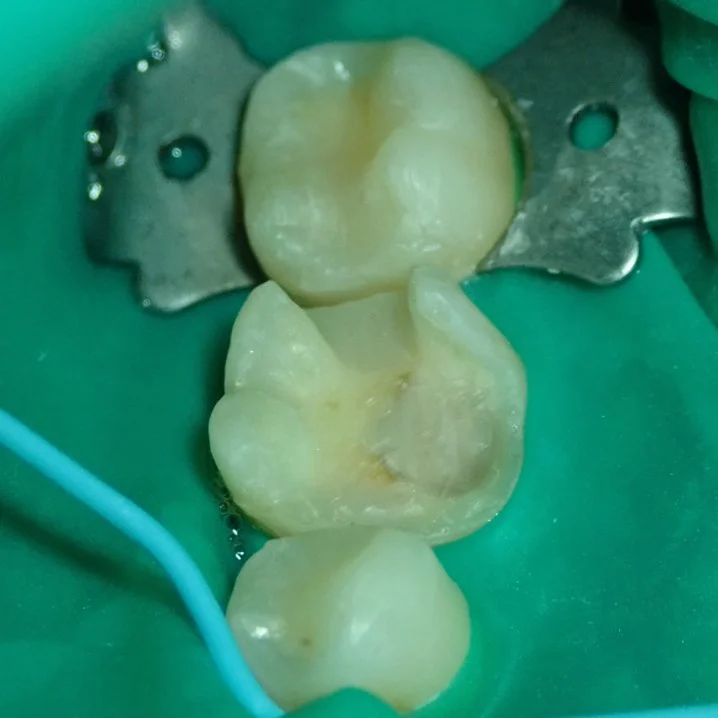 cavity